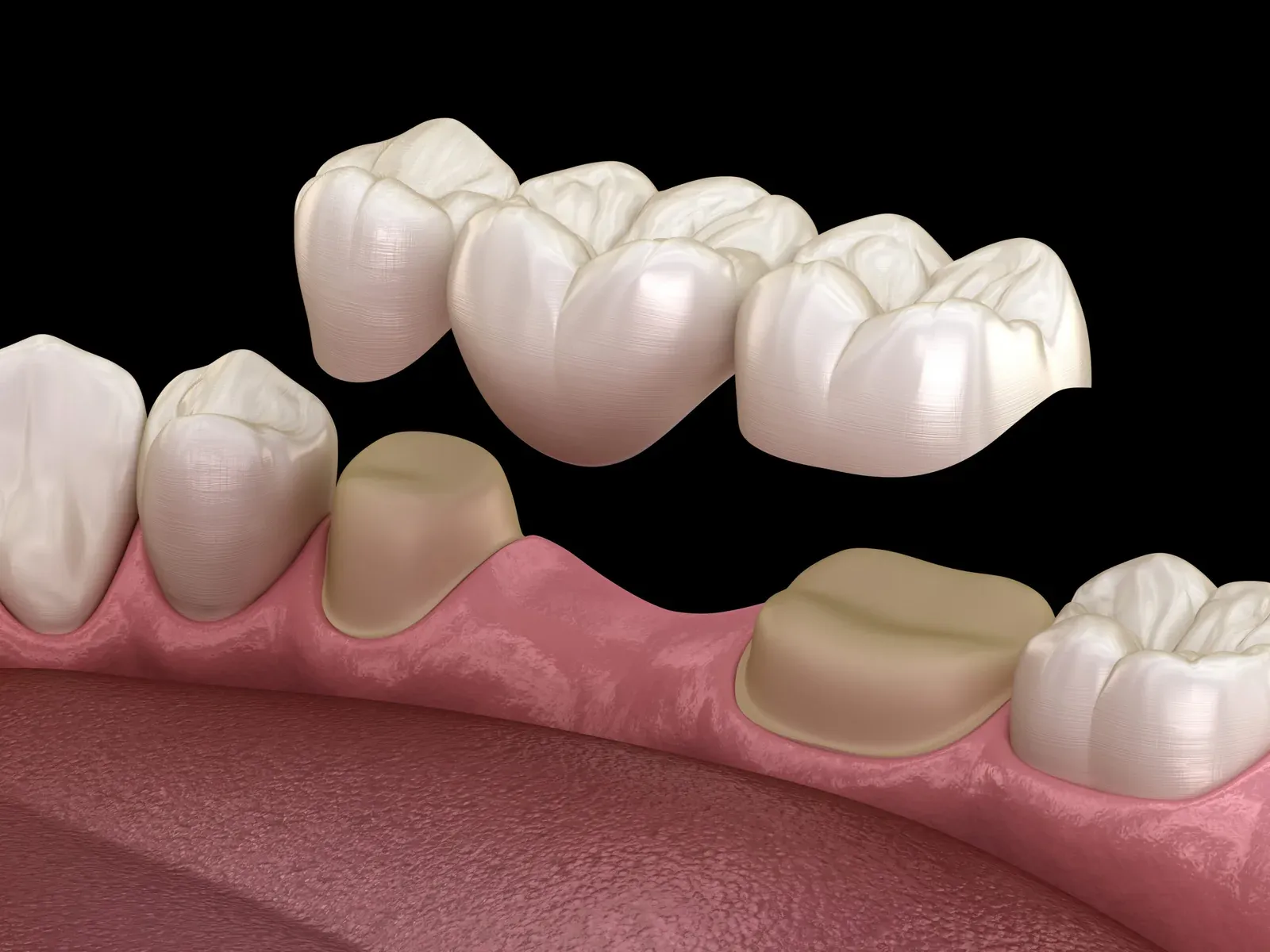 Dental Bridges at Southeastern Dental Care in Lakeville, MA