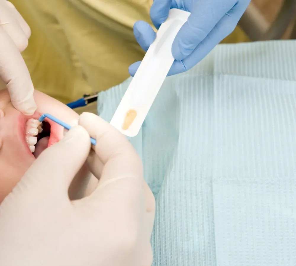 Fluoride Treatments at Southeastern Dental Care in Lakeville, MA