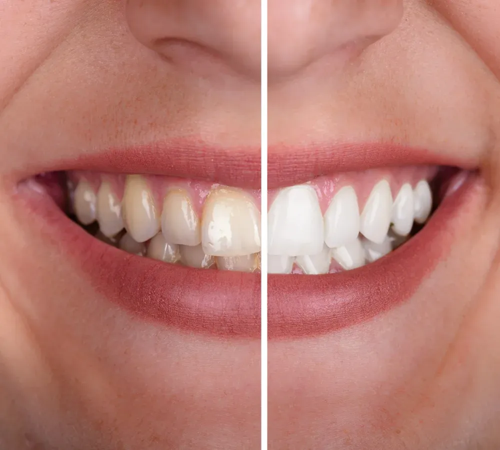 Teeth Whitening at Southeastern Dental Care in Lakeville, MA