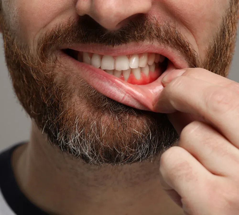 Periodontal Deep Cleanings at Southeastern Dental Care in Lakeville, MA