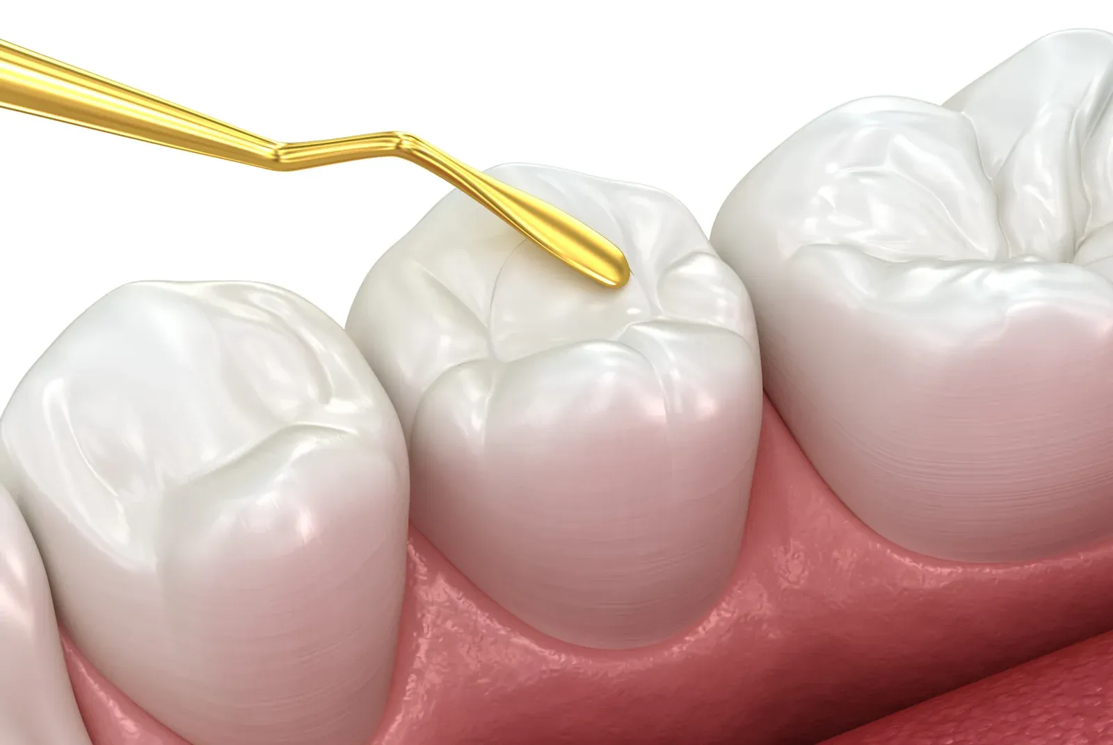 Fillings at Southeastern Dental Care in Lakeville, MA