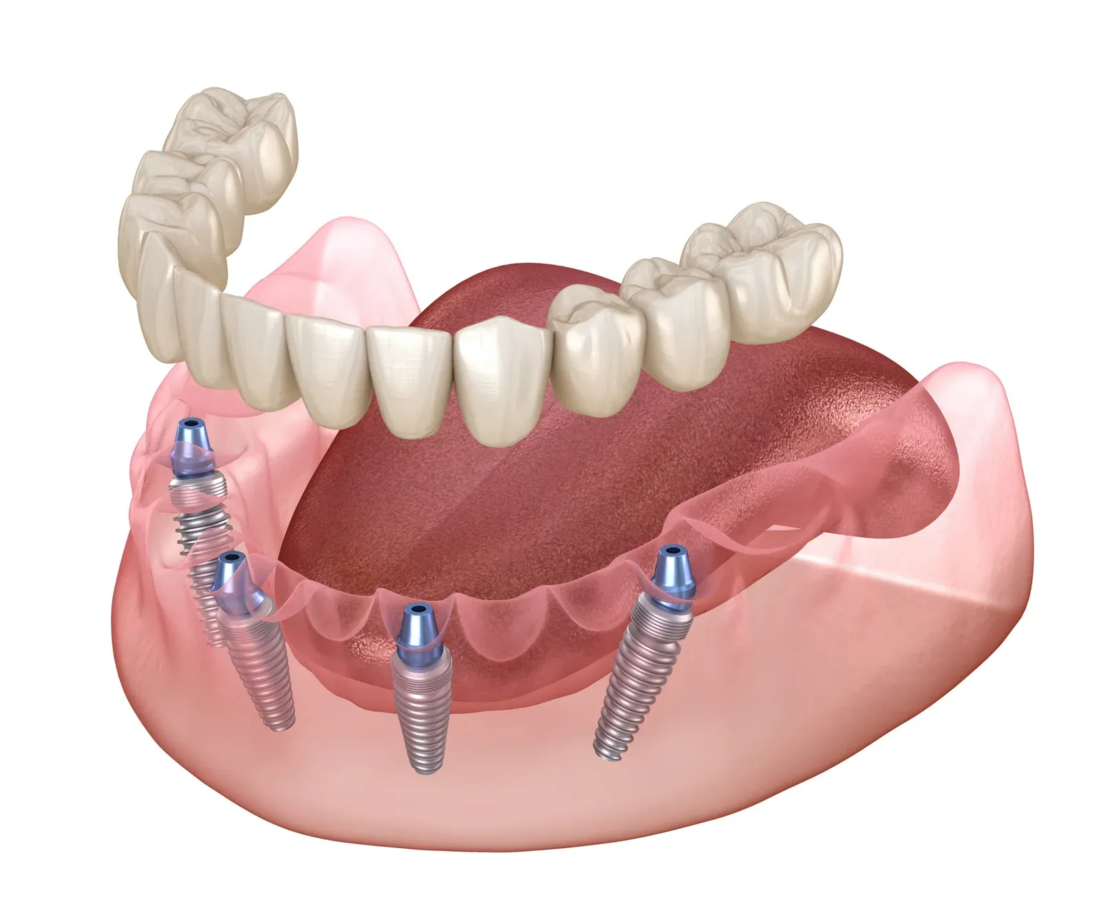 Full Arch Implants / Implant Retained Dentures at Southeastern Dental Care in Lakeville, MA