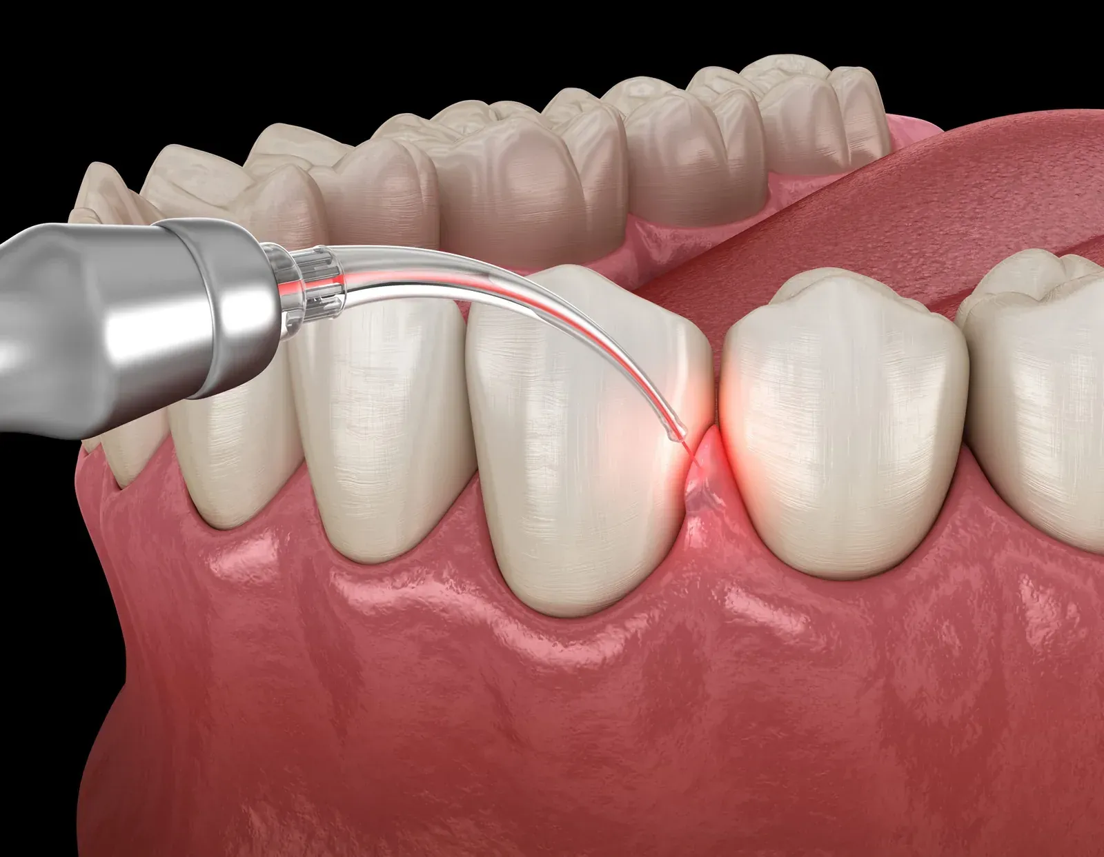 LANAP Laser Gum Treatment at Southeastern Dental Care in Lakeville, MA