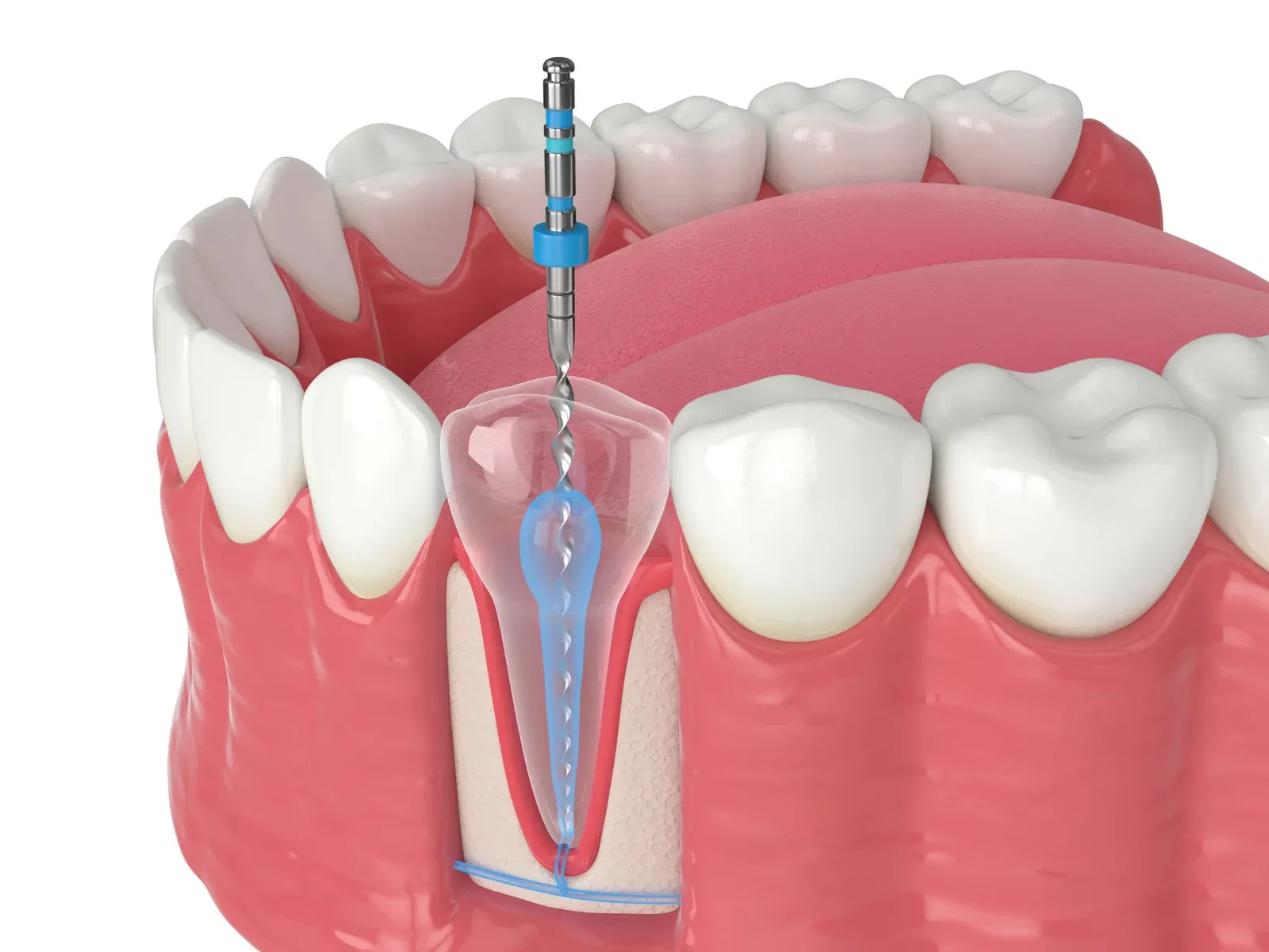 Root Canal Treatment at Southeastern Dental Care in Lakeville, MA